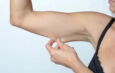 Arm Lift