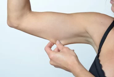 Arm Lift