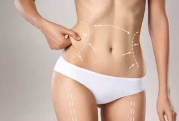 Liposuction