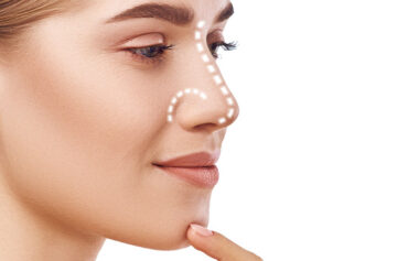 Rhinoplasty